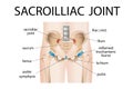 Inflammation of the sacroiliac joint of the lower back.